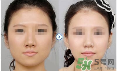 打瘦臉針疼不疼？打瘦臉針的注意事項(xiàng)