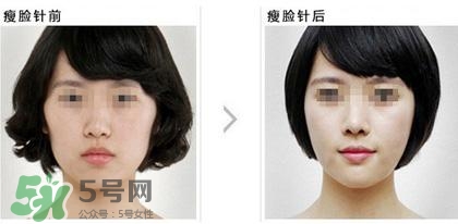 打瘦臉針能喝酒嗎？打瘦臉針能吃海鮮嗎？