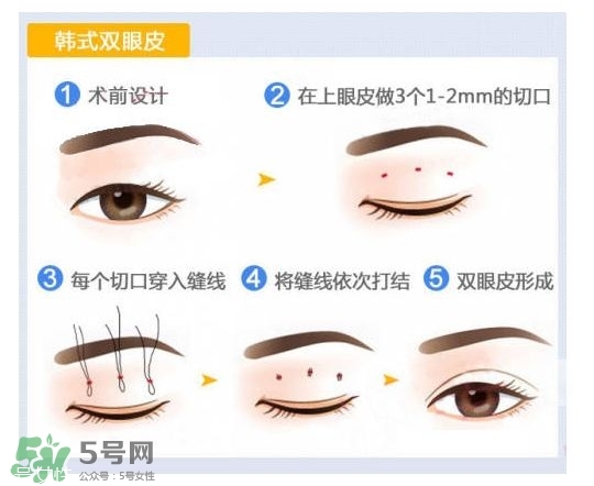 割雙眼皮有幾種做法？雙眼皮有哪幾種形狀？