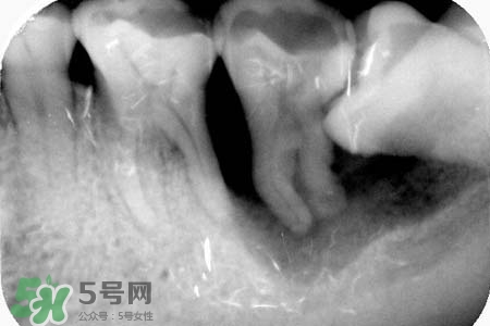 智齒會引起耳鳴嗎？耳鳴跟智齒有關(guān)系嗎？
