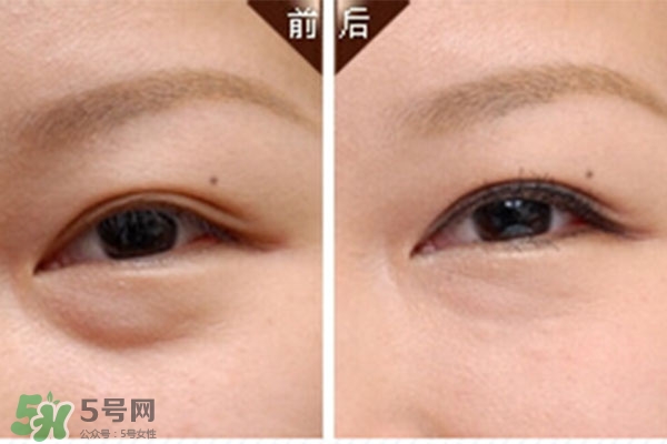 臥蠶是黑眼圈嗎？臥蠶和黑眼圈的區(qū)別