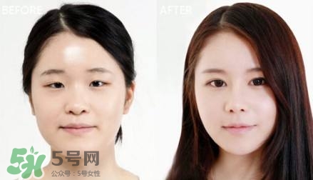 割雙眼皮有什么后遺癥嗎？割雙眼皮有什么危害性？