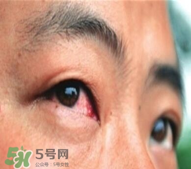 紅眼病是怎么引起的？紅眼病怎么產(chǎn)生的
