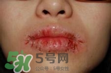 嘴唇干燥是什么原因？嘴唇干裂脫皮怎么辦？