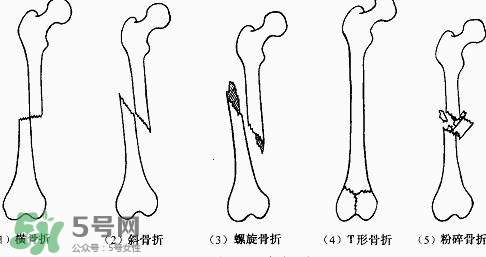 骨折吃什么好得快？骨折后注意事項