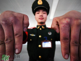 三月份還長凍瘡嗎？三月份凍瘡沒好怎么辦？