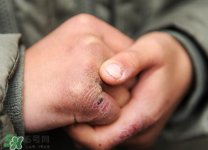 三月份還長凍瘡嗎？三月份凍瘡沒好怎么辦？