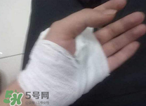 傷口化膿怎么處理？傷口化膿用什么藥好？
