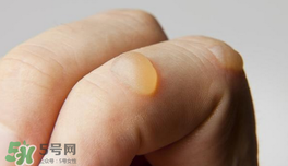 燙傷起泡要挑破嗎？燙傷起泡怎么處理？