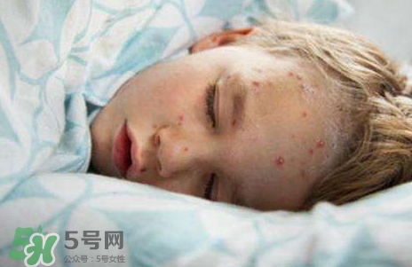 長(zhǎng)水痘可以吃雞蛋嗎?得水痘能吃雞蛋嗎?
