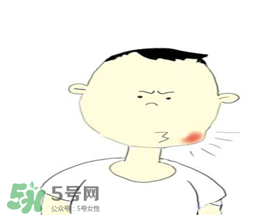 嘴角起泡是什么原因？嘴角起泡怎么辦？