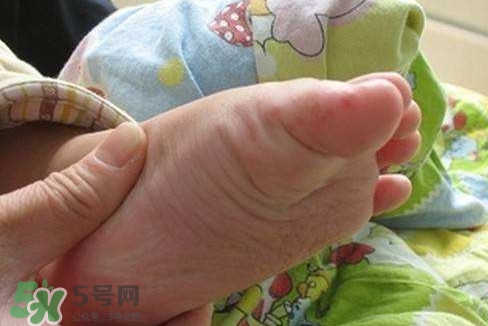 手足口病如何預(yù)防？手足口病怎樣預(yù)防