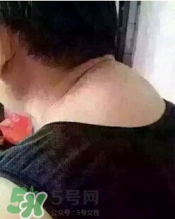 刮痧之后可以艾灸嗎？刮痧之后可不可以艾灸