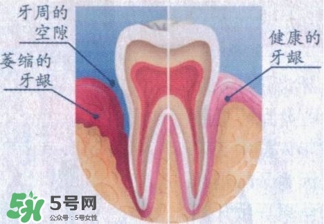 牙齦萎縮怎么辦？牙齦萎縮癥狀