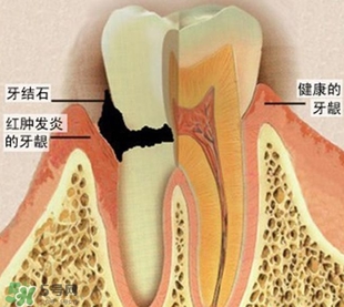 牙結石是什么？牙結石圖片