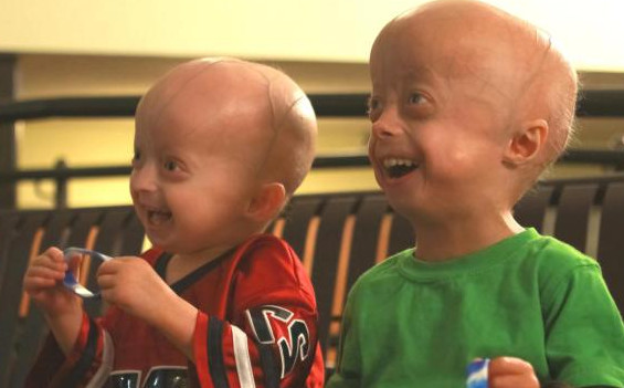 什么是早衰癥？早衰癥初期癥狀