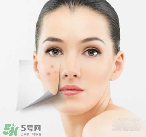 黑色痘印多久會消失？黑色痘印消失時間