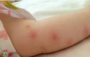 嬰兒蚊子咬了怎么消腫？嬰兒蚊子咬了怎么消腫止癢最快？