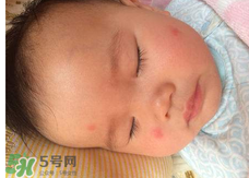 嬰兒蚊子咬了怎么消腫？嬰兒蚊子咬了怎么消腫止癢最快？