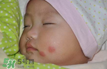 嬰兒被蚊子咬了如何去紅點？被蚊子咬后紅點如何去除？