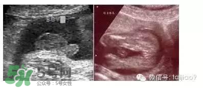 B超單數(shù)據(jù)怎么看男女？B超單看男女準嗎？