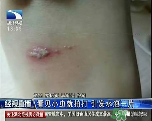 隱翅蟲有毒嗎？隱翅蟲會(huì)毀容嗎？