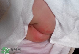 尿布疹怎么辦？寶寶尿布疹擦什么藥好？