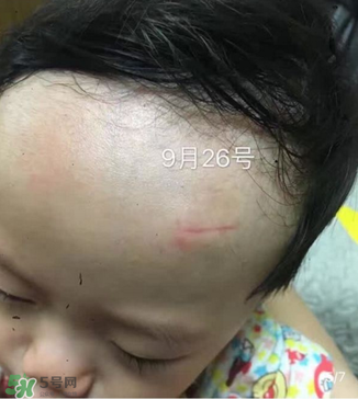 日本msd祛疤膏是抗生素嗎？日本msd祛疤膏是不是抗生素？