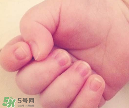 寶寶指甲凹凸不平是什么原因？寶寶指甲凹凸不平正常嗎？