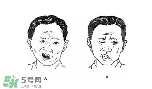 面癱是什么導(dǎo)致的？面癱多久徹底恢復(fù)正常