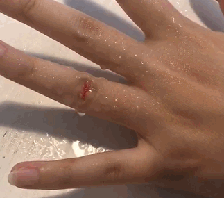 液體創(chuàng)可貼防水嗎？液體創(chuàng)可貼防水嗎透氣嗎？