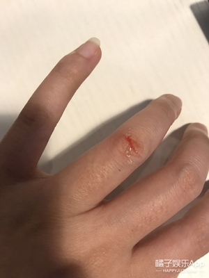 液體創(chuàng)可貼防水嗎？液體創(chuàng)可貼防水嗎透氣嗎？