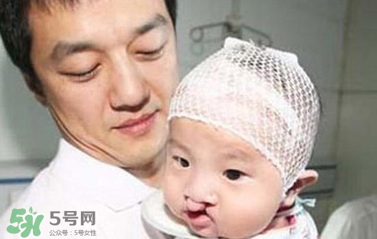 兔唇是什么？兔唇是什么原因造成的？