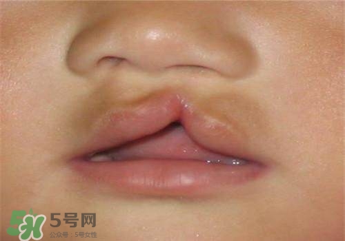 兔唇能檢查出來嗎？兔唇能完全修復(fù)嗎？