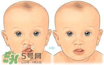 兔唇能檢查出來嗎？兔唇能完全修復(fù)嗎？