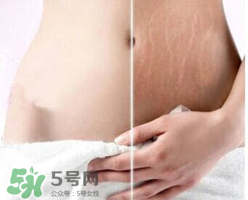 妊娠紋怎么長在大腿上了？妊娠紋會不會長在大腿上？