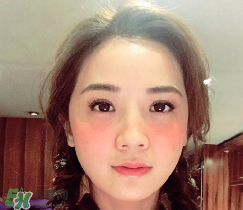 夏天可以點(diǎn)痣嗎？夏天點(diǎn)痣后要注意什么？