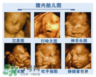 四維彩超有必要做嗎？四維彩超檢查不出什么？