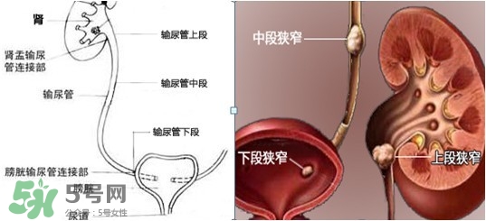 腎結石怎么治最好？腎結石的醫(yī)治方法