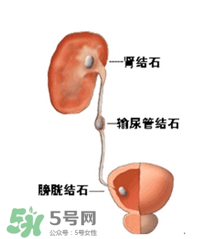 腎結(jié)石有什么癥狀？腎結(jié)石原因