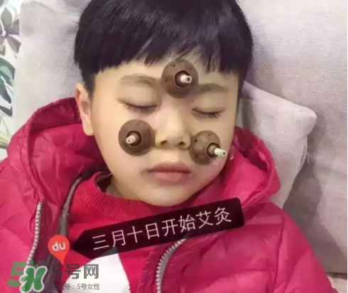艾灸貼可以治咳嗽嗎？艾灸貼可以治退燒嗎？