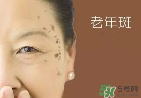 老年斑多大年齡開(kāi)始有？為什么牙膏能去老年斑？