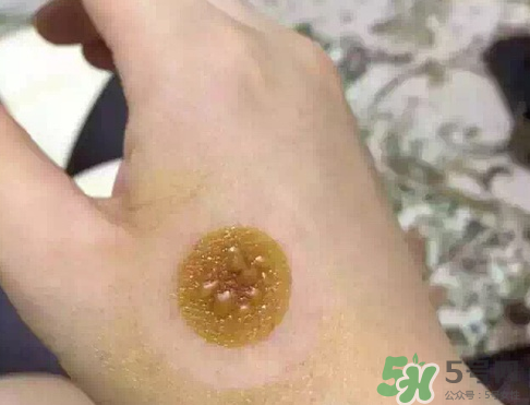 艾灸貼后有水泡怎么辦？貼艾灸貼應注意些什么？