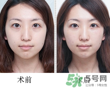 填充淚溝有風險嗎？填充淚溝的方法