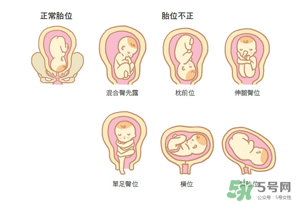 胎位不正如何矯正？胎位不正一定要剖腹產(chǎn)嗎？