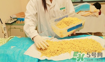 隔姜灸效果怎么樣？隔姜灸好還是直接灸好