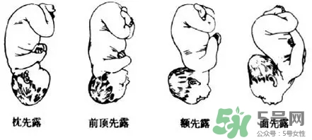 胎位不正能順產(chǎn)嗎？胎位不正怎么辦？