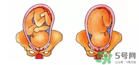胎位不正能順產(chǎn)嗎？胎位不正怎么辦？
