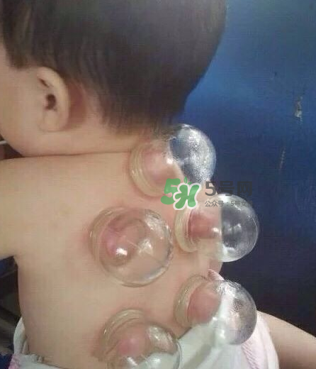 拔火罐后顏色多久消失？拔火罐印子多久能消除？