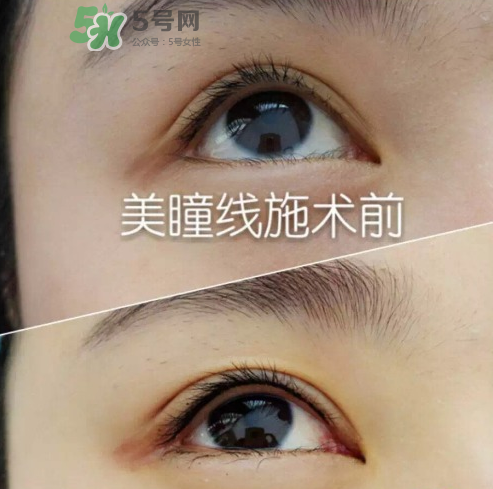 做美瞳線可以吃雞蛋嗎？做美瞳線能吃雞蛋嗎？